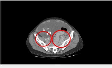 Figure 1 From Rapid Onset Chylous Ascites Presenting As The Initial