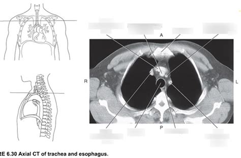 Axial Ct Of Trachea And Oesophagus Diagram Quizlet