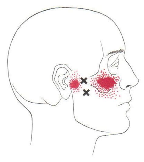 Ideal Balance Acupuncture Muscles Of Mastication