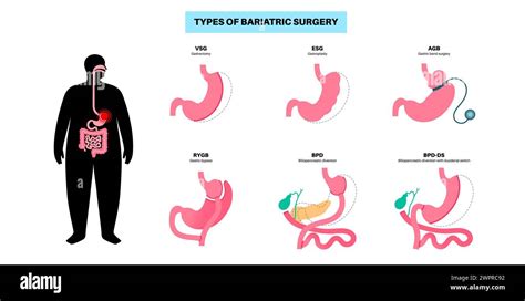 Types of bariatric surgery, illustration Stock Photo - Alamy