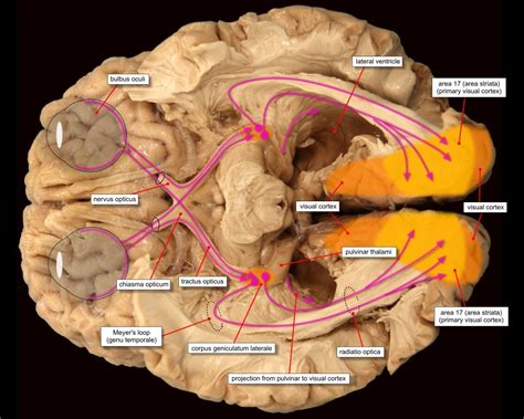 8649 optic radiation yeslabel | Anatomie, Medische illustratie ...