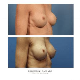 Breast Lift With Implants Grossman Capraro Plastic Surgery