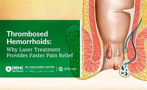 hemorrhoid how long does it take to heal