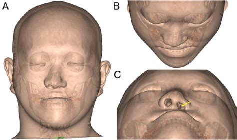 Representative Case Of Secondary Nasal Deformity In Adult Patients With Download Scientific