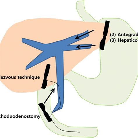 The Basic Steps Of Eus Guided Transmural Stenting A Eus Guided