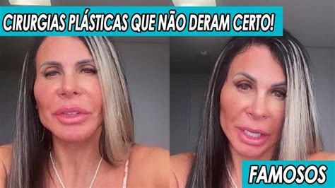 CIRURGIAS PLÁSTICAS EM FAMOSOS QUE NÃO DERAM CERTO YouTube