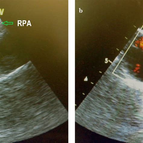 A B A Upper Oesophageal Ascending Aorta Short Axis View Showing