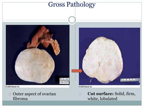 Sex Cord Stromal Tumors Pathology Ppt