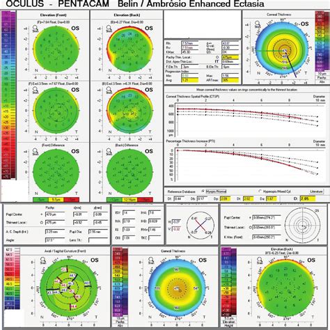 Ophthalmology Management Corneal Topography Tomography Off