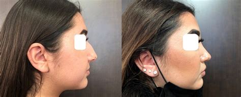 Dr Eric Bonafos Rhinoplastie à Montpellier Rhinoplastie Montpellier