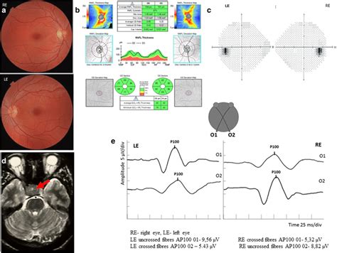 The Normal Results Of Fundus Examination A Oct B And Perimetry C