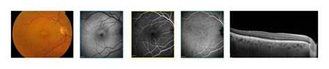 Color photograph shows macular atrophy and retinal flecks in a... | Download Scientific Diagram