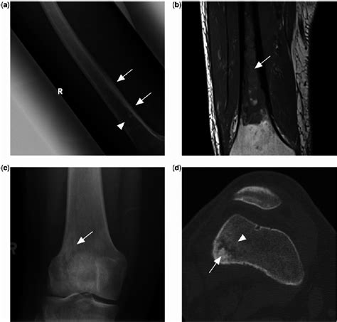 A Ill Defined Mixed Lytic Sclerotic Lesion In The Mid To Distal