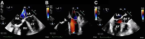 Pulmonary Vein Systolic Flow Reversal Seen With Severe Tricuspid