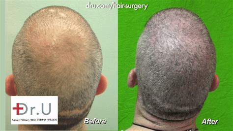 Video Body Hair Transplantation Restores Nw6 Thinning For A Buzz Cut