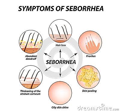 Symptoms Of Seborrhea. Seborrhea Skin And Hair. Dandruff, Seborrheic ...