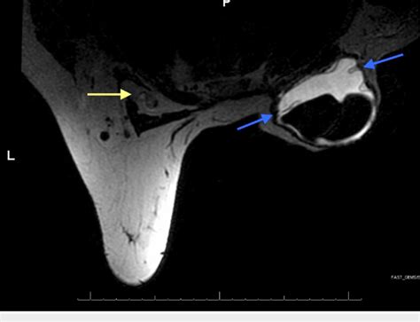 Preoperative MRI MRI Shows Multiple Keyhole Signs Blue Arrows