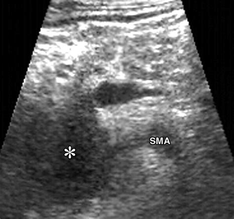 Intraoperative Ultrasonography Of The Pancreas Radiographics