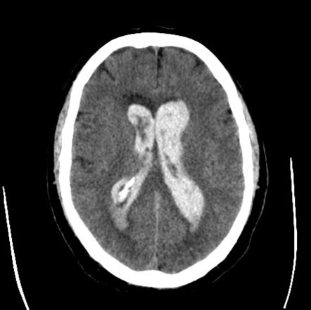 Intraventricular Hemorrhage Ultrasound