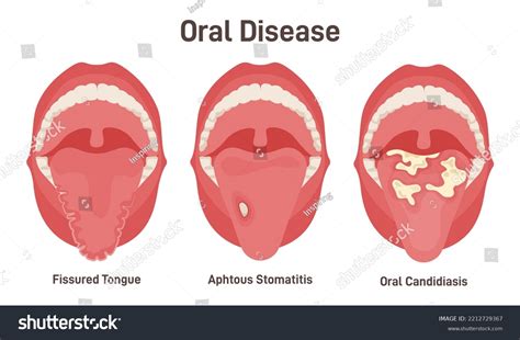 Tongue Problems Set Fissured Tongue Oral Royalty Free Stock Vector 2212729367