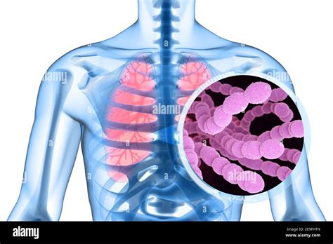 Grampositiver Streptococcus Pneumoniae Fotografías E Imágenes De Alta