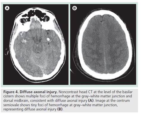 Diffuse Axonal Injury Mri