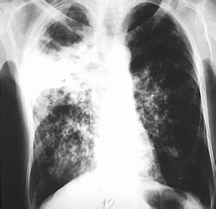 Tuberculosis chest x ray - wikidoc