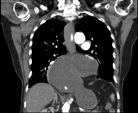 Organoaxial Gastric Volvulus Clinical Gastroenterology And Hepatology