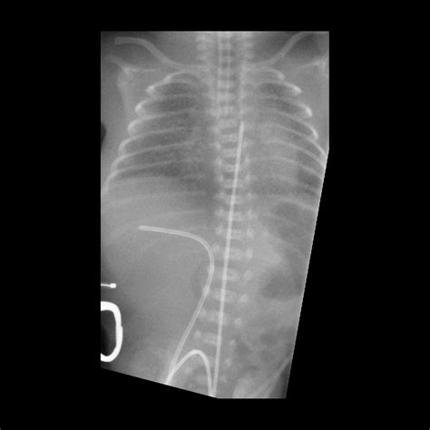 High Malposition Of The Umbilical Arterial Catheter Pacs