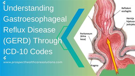 Understanding Gastroesophageal Reflux Disease Gerd Through Icd 10 Codes