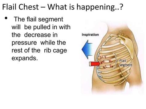 Flail Chest Ppt