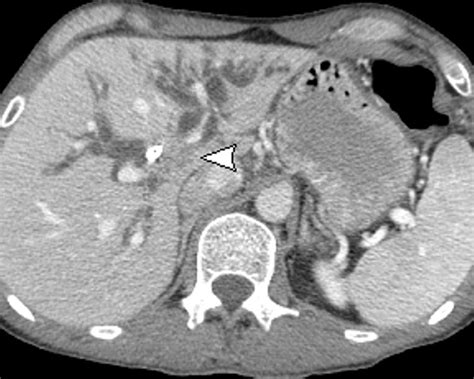 Klatskin Tumor Ultrasound