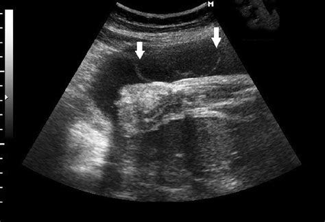 Prenatal Diagnosis Of Amniotic Band Syndrome In The Third Trimester Of