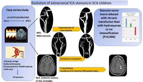 Stroke Aha Asa On Twitter Evolution Of Extracranial Internal Carotid