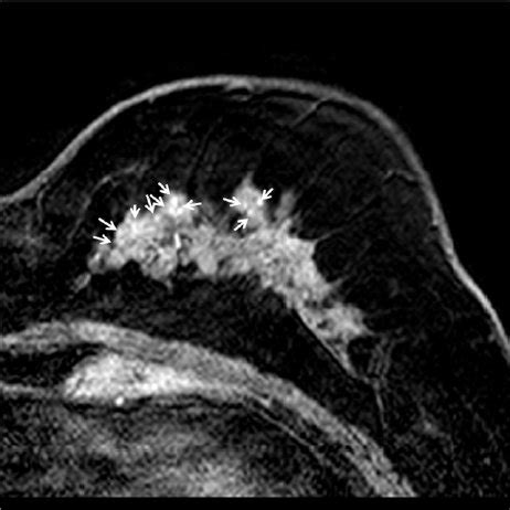 A. MLO view of mammography, B: CC view of mammography; Multiple ...