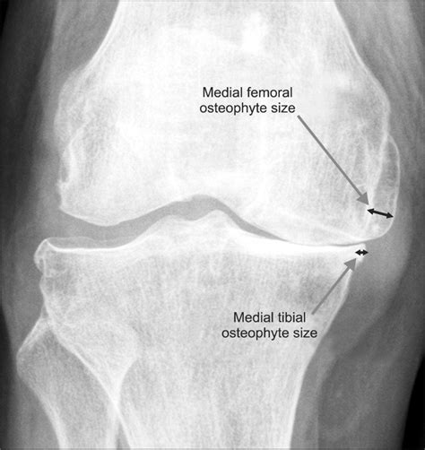 Osteophytes Knee