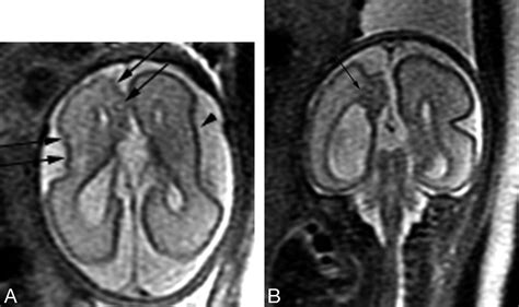 Complete Agenesis Of Corpus Callosum