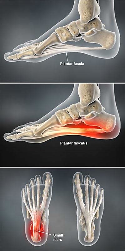 Plantar Fasciitis Central Coast Orthopedic Medical Group