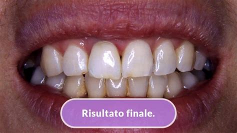 Sbiancamento Dente Devitalizzato Inside Outside Bleaching Studio