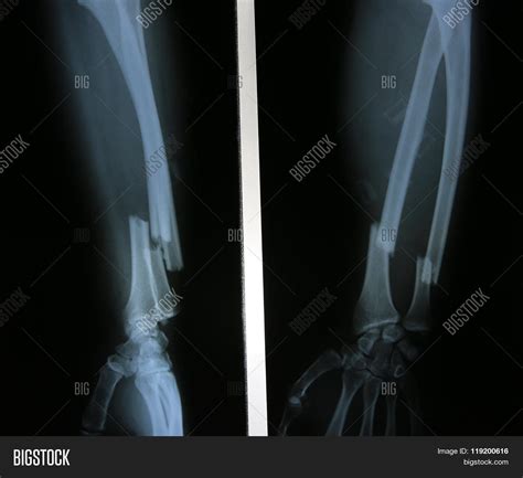 X Rays Images Bone Image Photo Free Trial Bigstock