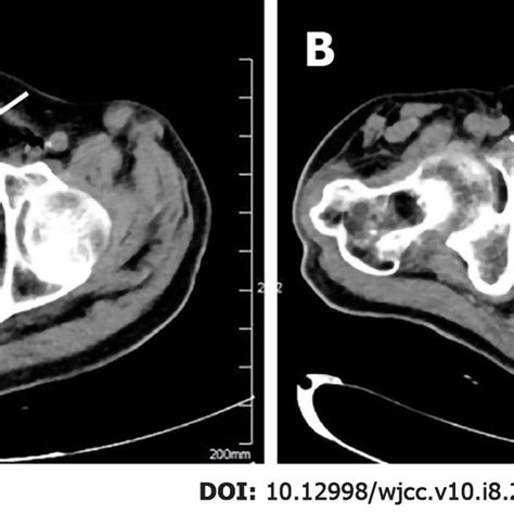 Pelvic Computed Tomography Scan Shows Emphysematous Cystitis Prostate