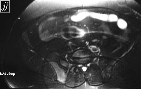 Right Iliac Bone Tumor Stir T2 Radiopaedia