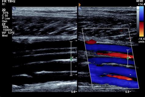 Where Can I Get A Vascular Ultrasound - ARVIYP