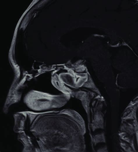 Post Trans Sphenoidal Resection Of The Sellarsuprasellar Tumour