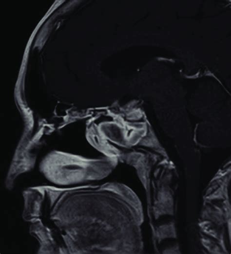 Post Trans Sphenoidal Resection Of The Sellar Suprasellar Tumour