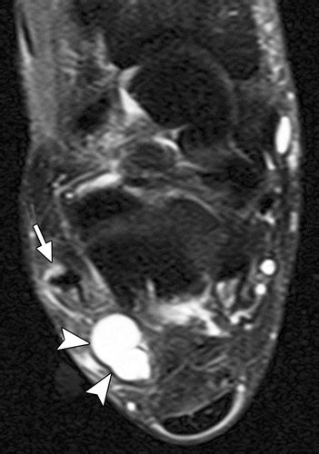 High Resolution Us And Mr Imaging Of Peroneal Tendon Injuries Radiographics