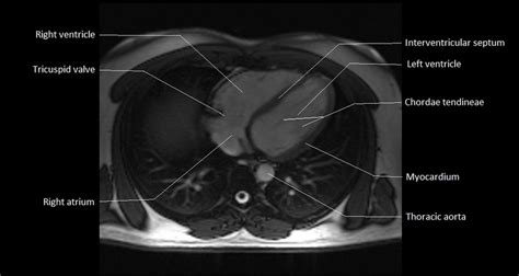 MRI Anatomy of Heart | Free MRI Axial Heart Cross Sectional Anatomy