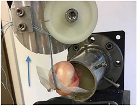 Figure 1 from Conventional rotator cuff versus all-suture anchors—A ...