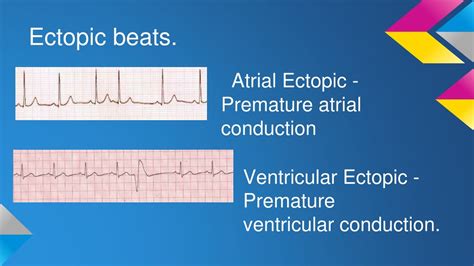 Ppt Ecg Rhythm Recognition Powerpoint Presentation Free Download