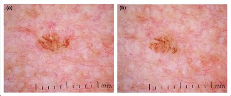 A Dermoscopic View Of A Lesion Suspected To Be An Intradermal Naevus